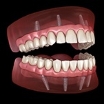 Implant dentures in St. Johns