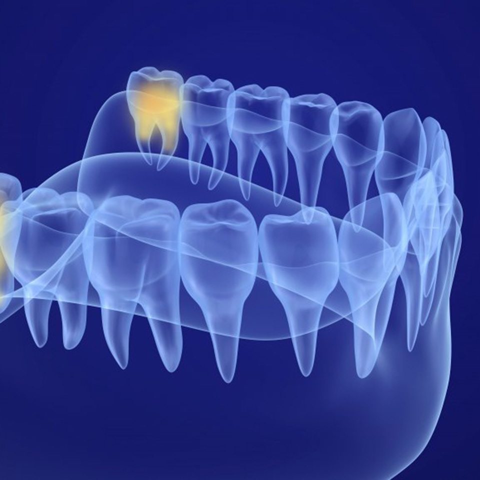 Digital diagram of wisdom teeth location